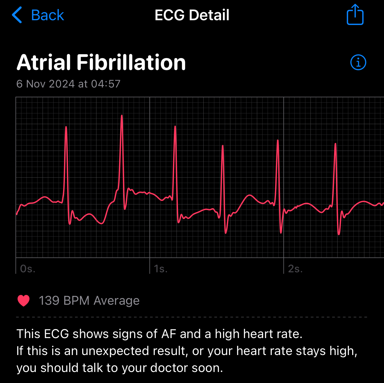 ECG from an Apple Watch showing atrial fibrillation and a high heart rate